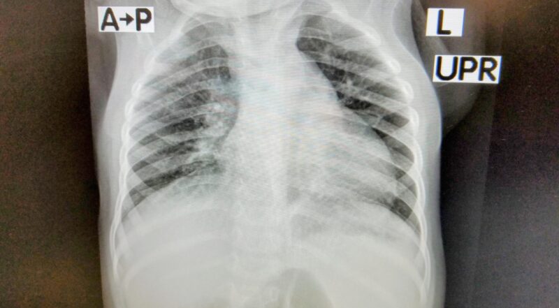 lung xray